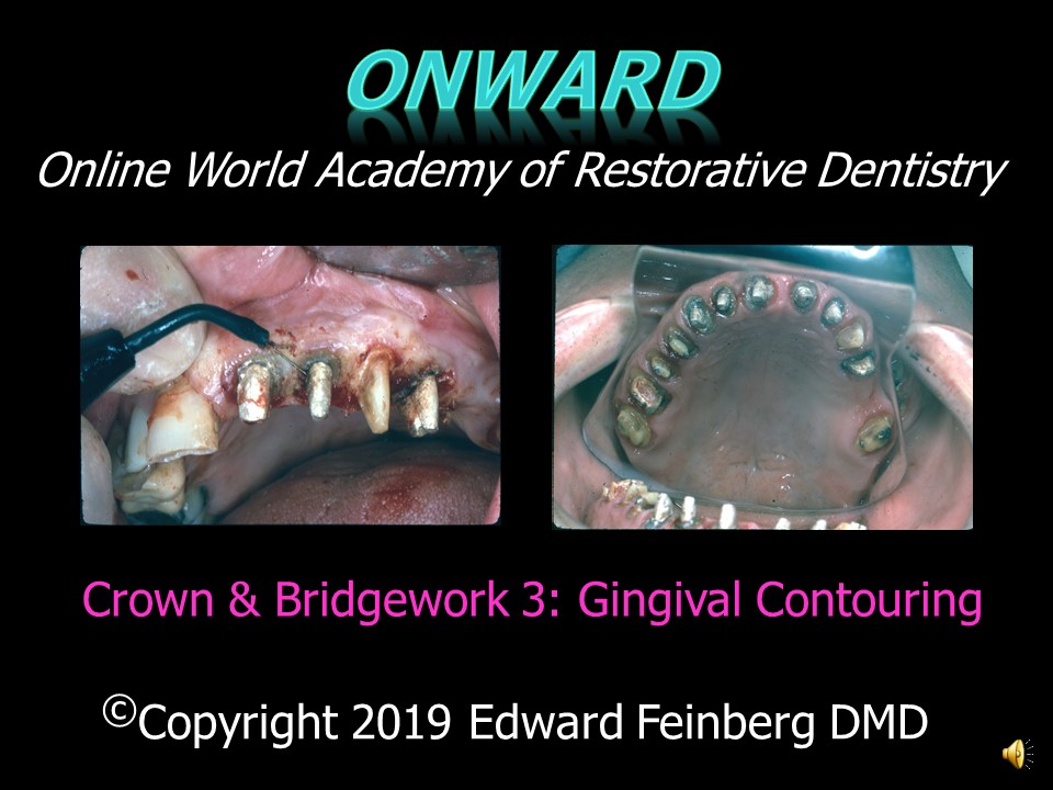 Crown and Bridge 3 - How to Prepare the Gingiva around Full Shoulder Crown and Bridge Preparations
