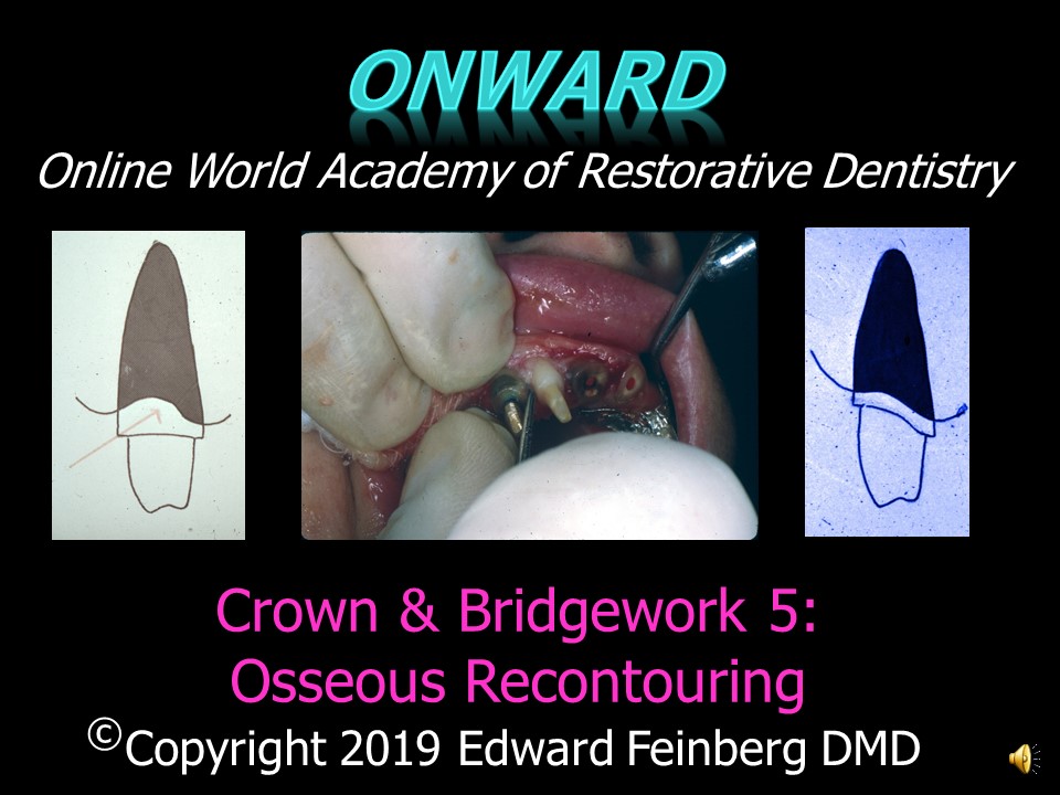 Crown and Bridge 5 - Indications and Techniques for Successful Osseous Contouring around Full Shoulder Crown and Bridge Preparations
