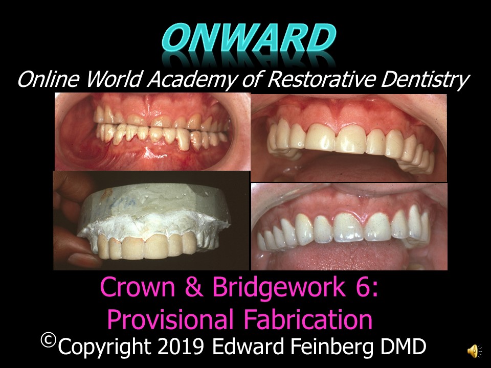 Crown and Bridge 6 - Fabrication of Provisional Restorations