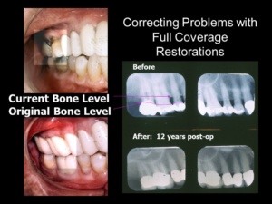 Correcting Problems with Full Coverage Restorations