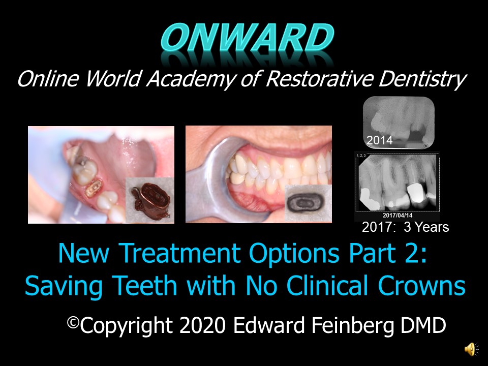 Saving Teeth with No Clinical Crowns Part II